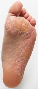 athlete's foot image