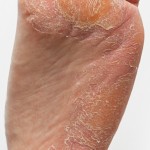 athlete's foot image
