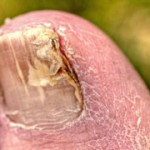 nail fungus cure image