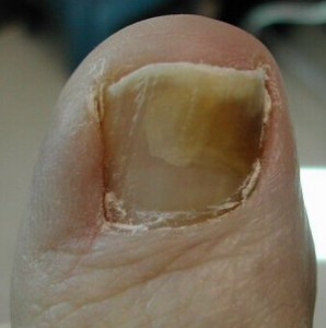 nail fungus cure image